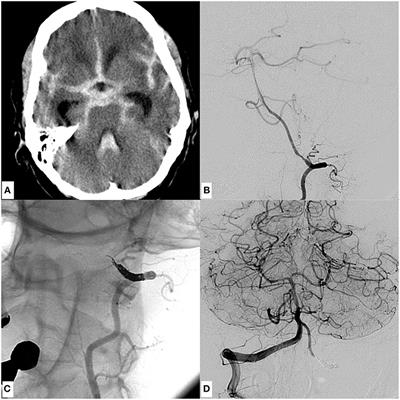 Segment Occlusion vs. Reconstruction—A Single Center Experience With Endovascular Strategies for Ruptured Vertebrobasilar Dissecting Aneurysms